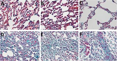 Changing Expression Profiles of Messenger RNA, MicroRNA, Long Non-coding RNA, and Circular RNA Reveal the Key Regulators and Interaction Networks of Competing Endogenous RNA in Pulmonary Fibrosis